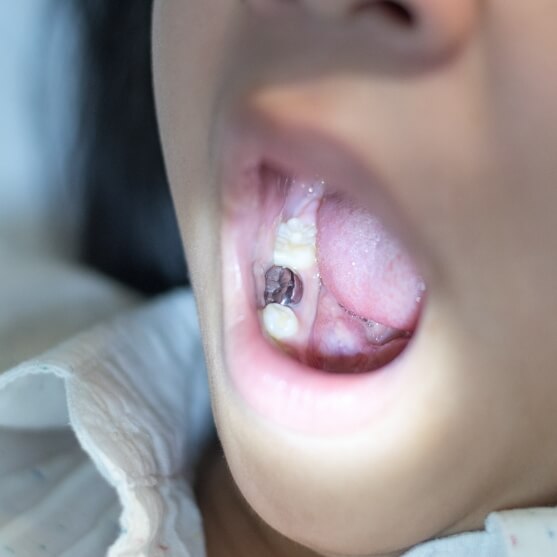 Child in need of dental sealants with dental crown repairing decayed tooth