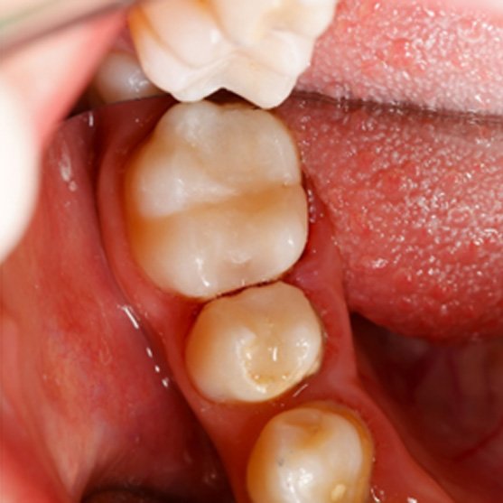 Before and after tooth-colored fillings in Derby, KS