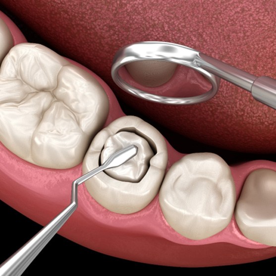 Illustration of placing tooth-colored fillings in Derby, KS