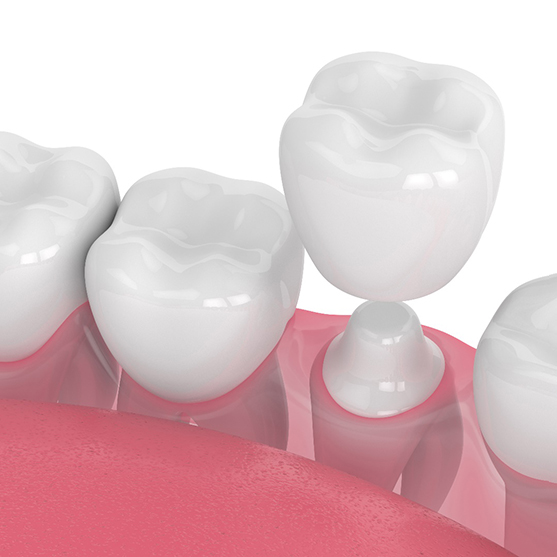 3D illustration Dental crowns in Derby