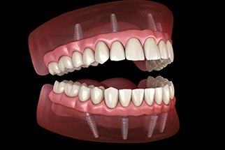 All-on-4 dentures