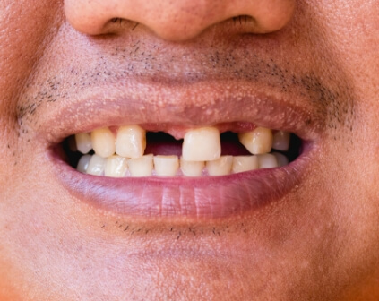 Smile with multiple missing teeth