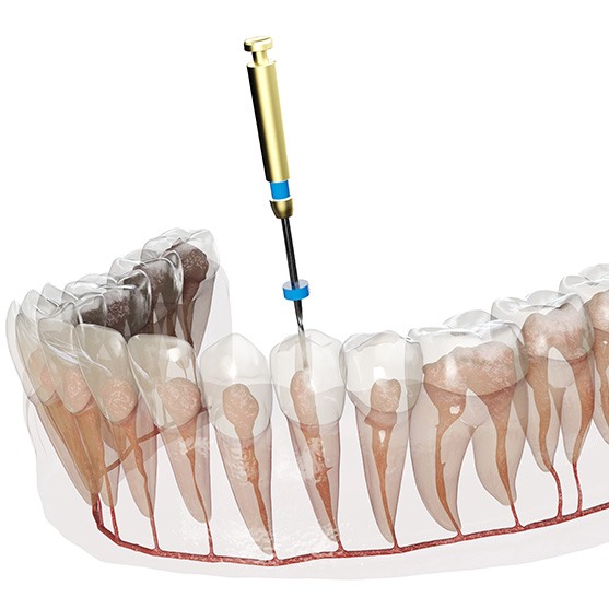 Illustrated image of dental instrument clearing tooth infection