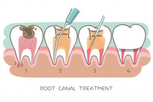 dentist filling patient’s root canal 