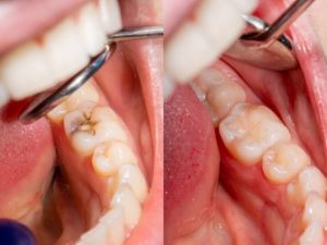 a before-and-after side-by-side display of a tooth with a cavity and the same tooth with a filling and no apparent cavity