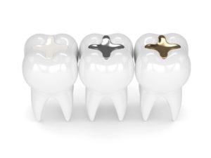 image of three teeth with dental fillings