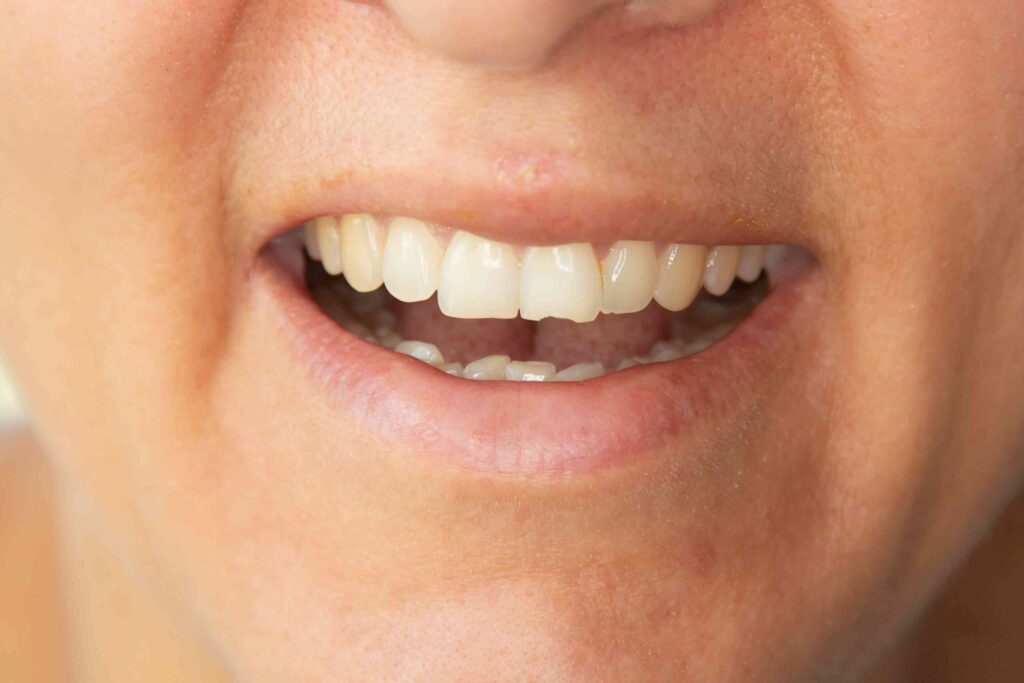 Man with a chipped tooth
